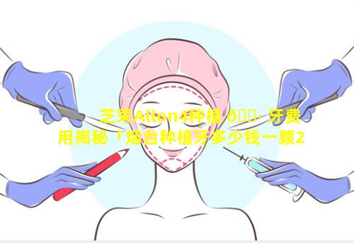 芝罘Allon4种植 🕷 牙费用揭秘「烟台种植牙多少钱一颗2021价格表 🪴 」